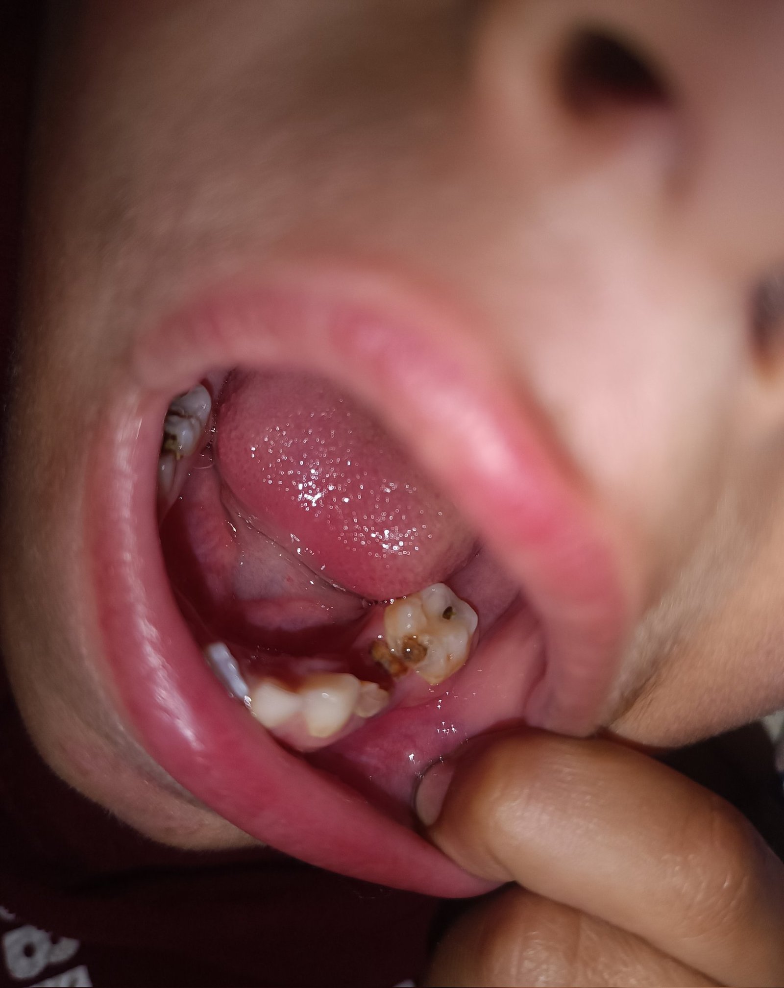 Why Do You Have Dental Problems Even After Brushing? Ayurvedic Tips for Healthy Teeth and Gums